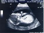 21 Weeks In Utero